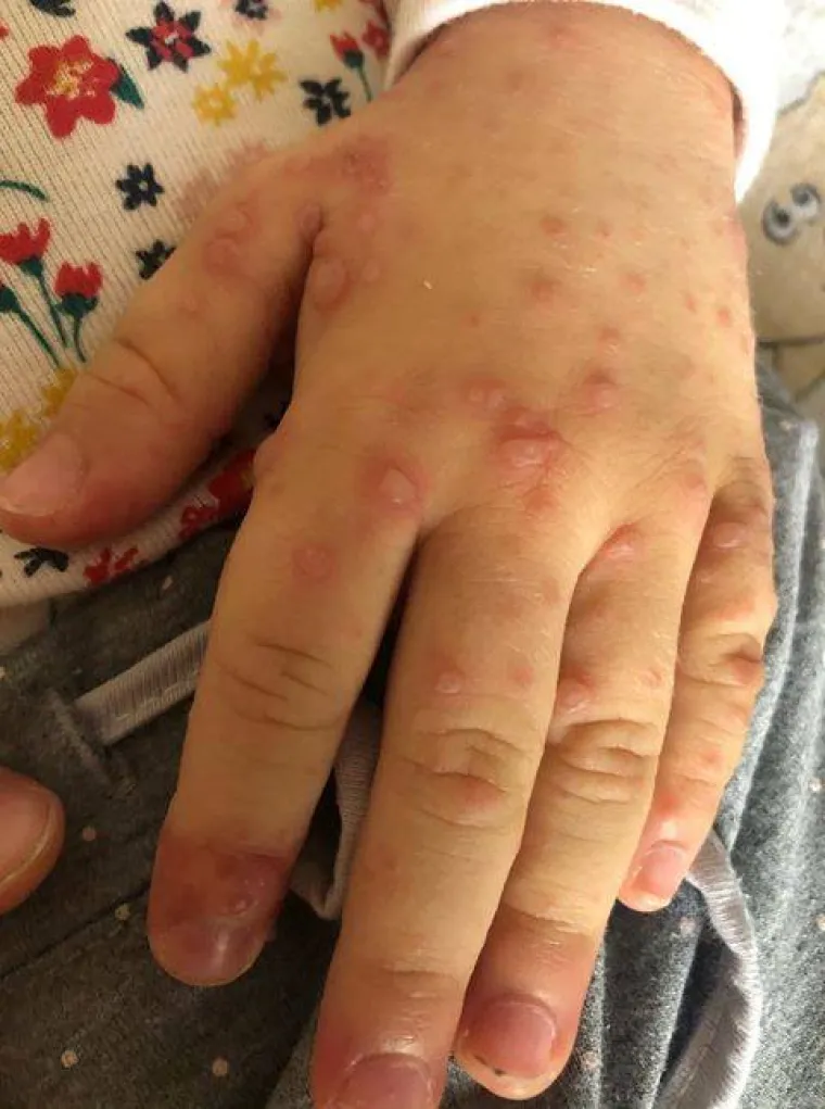 Prvo se razboljela kćerkica, a ubrzo su se temperatura i plikovi pojavili i kod roditelja