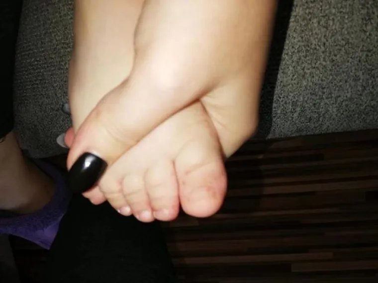 Prvo se razboljela kćerkica, a ubrzo su se temperatura i plikovi pojavili i kod roditelja