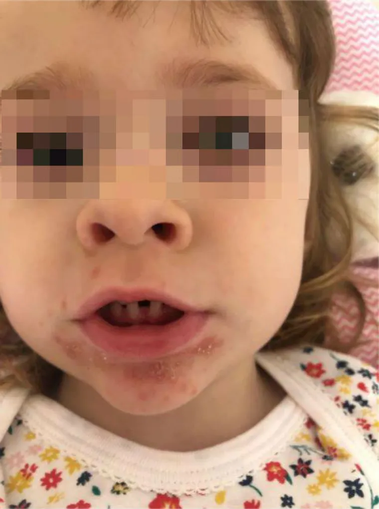 Prvo se razboljela kćerkica, a ubrzo su se temperatura i plikovi pojavili i kod roditelja