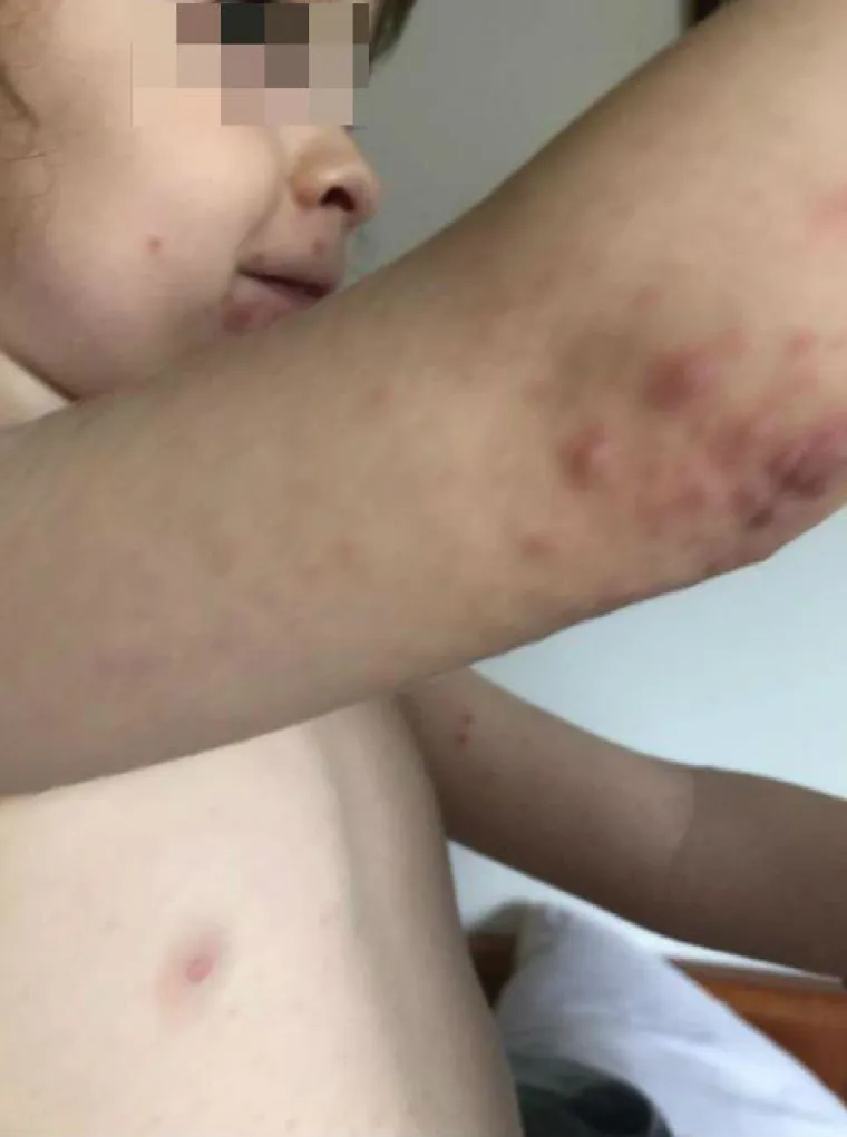 Prvo se razboljela kćerkica, a ubrzo su se temperatura i plikovi pojavili i kod roditelja