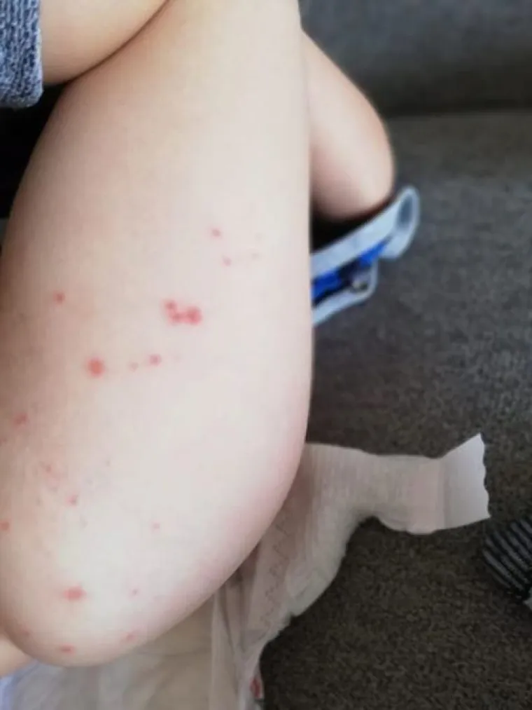 Prvo se razboljela kćerkica, a ubrzo su se temperatura i plikovi pojavili i kod roditelja