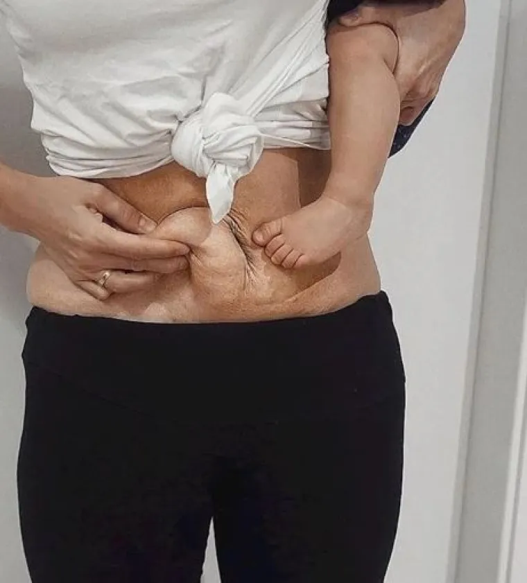 Za svaku pohvalu: 20 trudnica pokazalo svoj 'nesavr&scaron;eni' trbuh nakon poroda