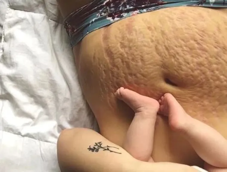 Za svaku pohvalu: 20 trudnica pokazalo svoj 'nesavr&scaron;eni' trbuh nakon poroda