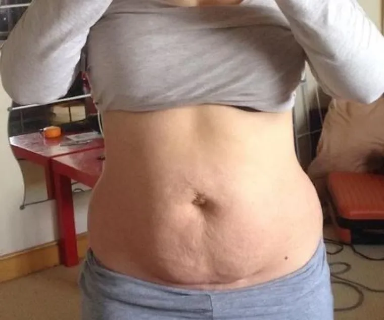 Za svaku pohvalu: 20 trudnica pokazalo svoj 'nesavr&scaron;eni' trbuh nakon poroda