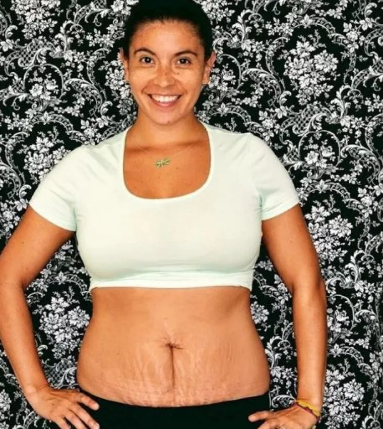 Za svaku pohvalu: 20 trudnica pokazalo svoj 'nesavr&scaron;eni' trbuh nakon poroda