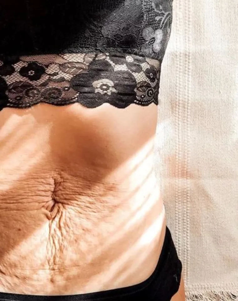 Za svaku pohvalu: 20 trudnica pokazalo svoj 'nesavr&scaron;eni' trbuh nakon poroda