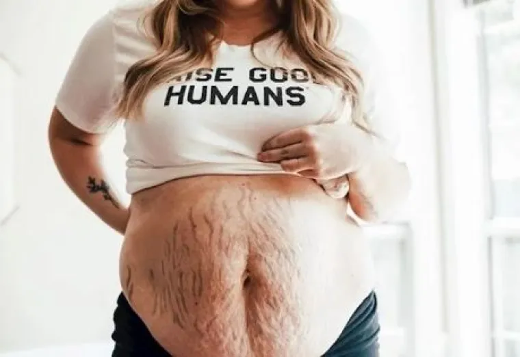 Za svaku pohvalu: 20 trudnica pokazalo svoj 'nesavr&scaron;eni' trbuh nakon poroda