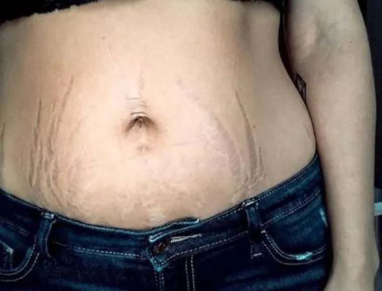 Za svaku pohvalu: 20 trudnica pokazalo svoj 'nesavr&scaron;eni' trbuh nakon poroda