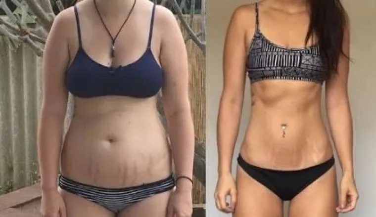 Za svaku pohvalu: 20 trudnica pokazalo svoj 'nesavr&scaron;eni' trbuh nakon poroda