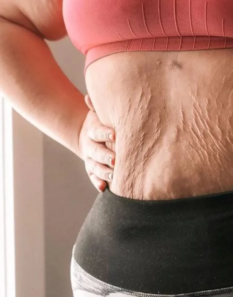 Za svaku pohvalu: 20 trudnica pokazalo svoj 'nesavr&scaron;eni' trbuh nakon poroda