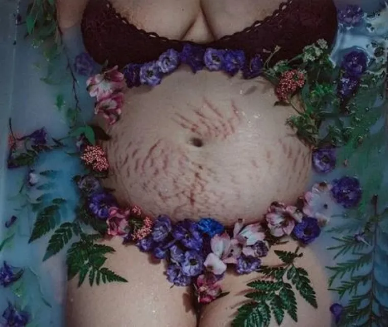 Za svaku pohvalu: 20 trudnica pokazalo svoj 'nesavr&scaron;eni' trbuh nakon poroda