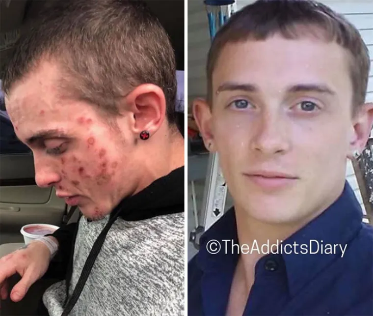 OSTAVILI SU SE DROGE, A DANAS IZGLEDAJU OVAKO: Biv&scaron;i ovisnici pokazali razlike koje će vas osupnuti