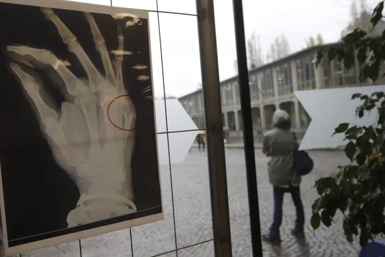 Rendgen govori tisuću riječi: Izložene snimke slomljenih kostiju pretučenih žena