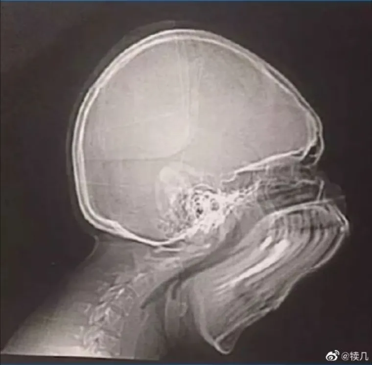 Kihnuo je tijekom snimanja rengena