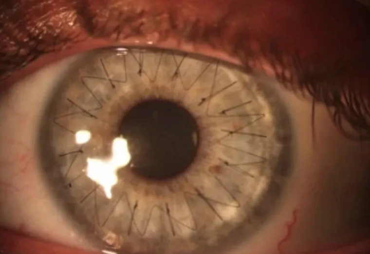 Rožnica nakon operacije oka