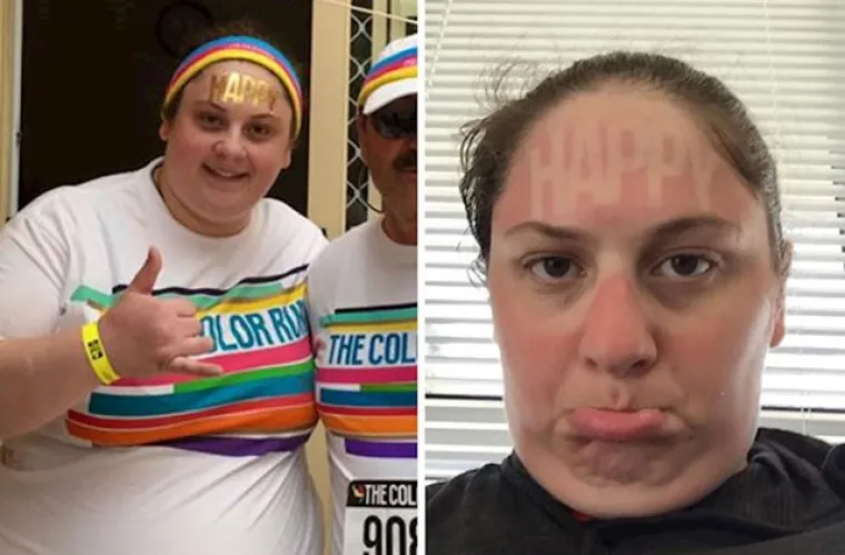 Zaspali pa 'izgorjeli': Ovi ljudi su požalili &scaron;to su zaboravili kremu za sunčanje