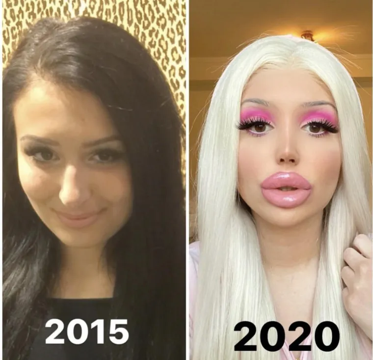 Jedne jednostavno nisu znale stati s plastičnim operacijama jer su opsjednute lutkom Barbie....