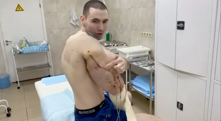 U jednom trenutku prijetila mu je amputacija obje ruke, no liječnici su ih uspjeli spasiti. Uklonili su mu mrtvo tkivo iz ruku, a Tereshin je prošao niz operacija kako bi se oporavio.