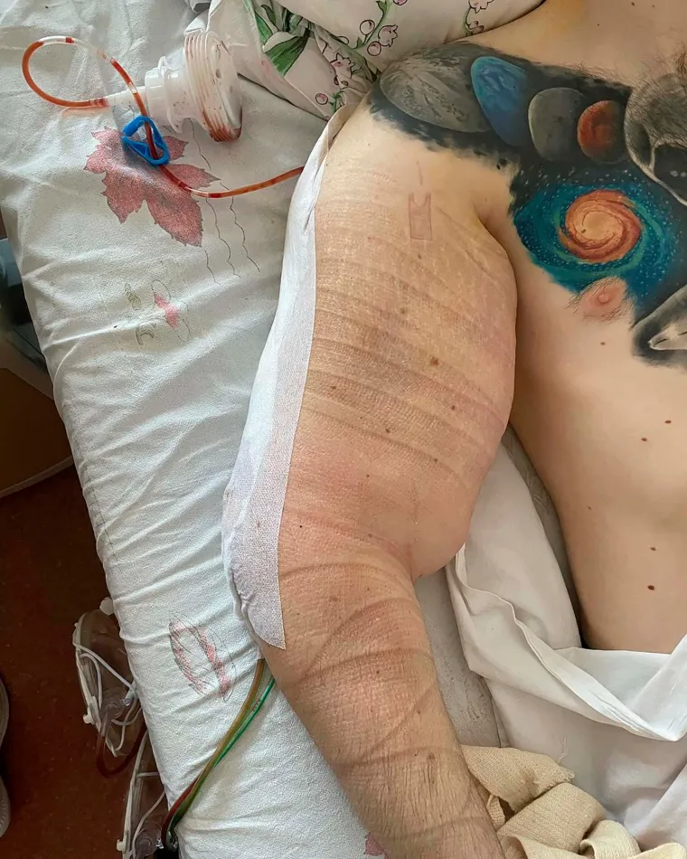 Zahvalan je što je naišao na liječnika koji je znao kako riješiti njegov problem. Čeka ga najvažnija operacija oko bicepsa, gdje je tkivo dosta osjetljivo i puno živaca.