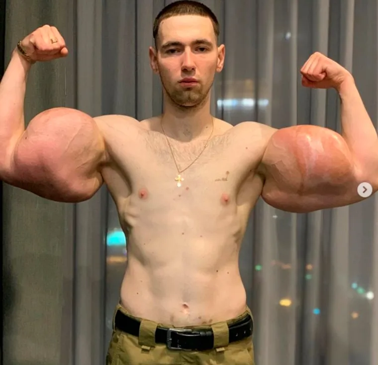 Kirill Tereshin, 24-godišnji ruski MMA borac, dobio je nadimak Popaj zbog svojih ogromnih bicepsa i tricepsa. No, oni nisu nastali isključivo vježbanjem, već je mladić u njih ubrizgavao vazelin i razne druge supstance kojima ih je pokušavao povećati. Zbog pandemije koronavirusa operacija kojom bi mu se uklonili opasni implantati je odgođena.