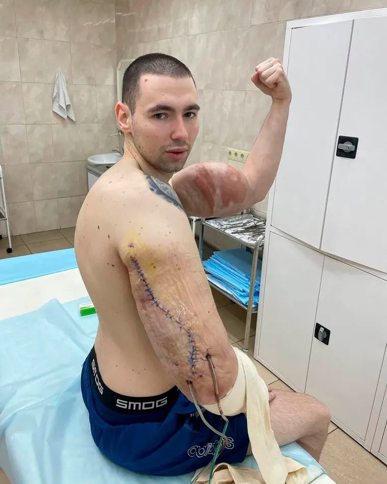 RUSKI POPAJ UMALO OSTAO BEZ RUKU: Uštrcavao si vazelin u mišiće, sad se užasno kaje; čeka ga operacija života