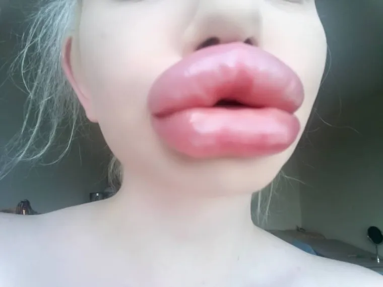 U svoje je usne Andrea ubrizgala više od 20 injekcija hijaluronske kiseline.