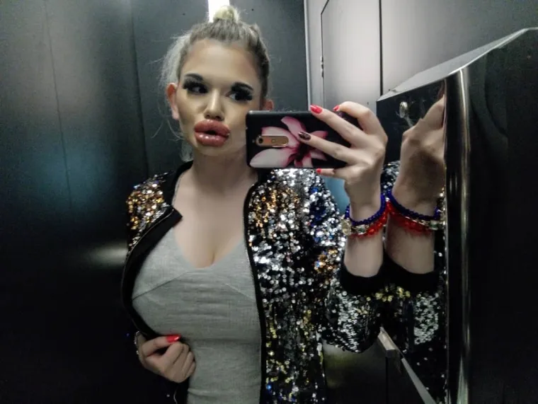 JAO, PA &Scaron;TO JE NAPRAVILA OD SEBE?! Svi joj govore da je pretjerala sa zahvatima, ali Andrea ne misli stati: 'Želim jo&scaron; veće!'