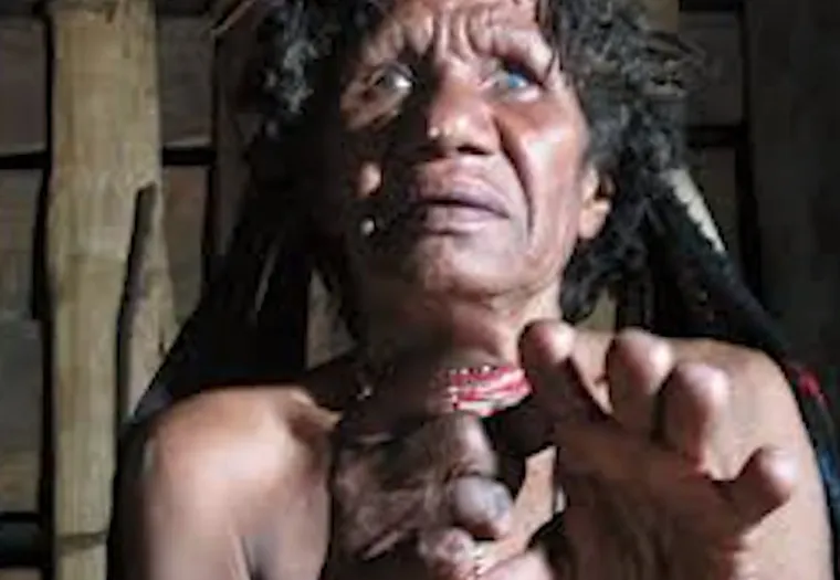 5. Rezanje prstiju (Papua): Kažu da gubitak voljene osobe može biti poput gubitka dijela sebe. Za žene iz plemena Dani na indonezijskom otoku Papui, ovo se vjerovanje shvaća doslovno. Od onih koji su ožalošćeni, nekad se tražilo da amputiraju vrhove prstiju - kako zbog izražavanja tuge, tako i radi čuvanja od potencijalno osvetoljubivih duhova pokojnika. Iako je ovaj ritual proglašen ilegalnim, i dalje se, prema nekim glasinama, nastavlja provoditi u izoliranim plemenima.