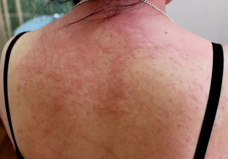 1.	Osip
Mnogi su se požalili na niz problema s kožom nakon što su se zarazili koronavirusom. No njih nije izazvao sam virus nego (pretjerana) reakcija imunosnog sustava zbog kojeg dolazi do oštećenja kapilara. Neke je koža neprestano svrbjela, drugi su dobili osip, a jedna pacijentica dobila toliko snažan osip da su joj usnice natekle i morala je potražiti pomoć liječnika. U bolnici su otpisali njene simptome kao potpuno nevezane uz covid, te su joj propisali antihistaminike. 
No studije su pokazale kako problemi na koži prate čak 26 posto slučajeva zaraze koronavirusom, a objašnjenje je relativno jednostavno – kako virus uništava stanice otpušta se histamin što pak potiče reakciju imuniteta. 