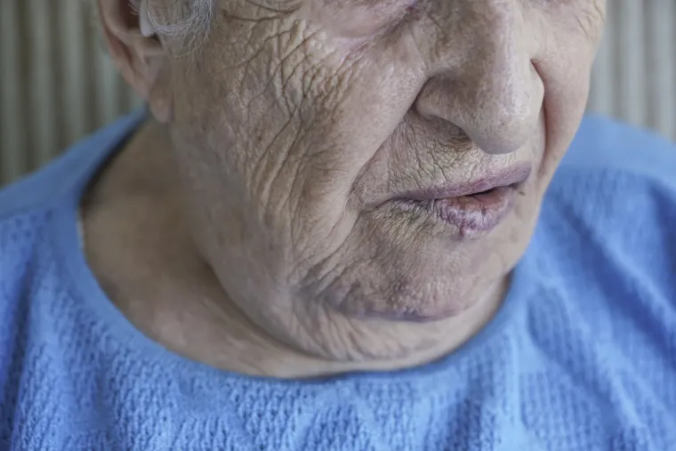 3. Paraliza lica: Moždani udar često zahvaća mi&scaron;iće lica. Tada jedna strana lica pada ili postaje potpuno utrnuta zbog čega lice izgleda asimetrično. Ovo je najuočljiviji simptom. Ako mislite da netko ima moždani udar, zamolite osobu da se nasmije&scaron;i. Ovo je brz način da se utvrdi dijagnoza. Ako dođe do paralize lica, odmah pozovite hitnu pomoć. Čak i ako asimetričan osmijeh ili pote&scaron;koće s govorom nisu posljedica moždanog udara, jo&scaron; uvijek su znak da je ne&scaron;to ozbiljno posrijedi. Rehabilitacijska terapija igra ključnu ulogu u oporavku od paralize lica. Neki preživjeli pacijenti s vremenom se u potpunosti oporave od paralize lica, ali za mnoge ljude je trajna. Ovaj simptom uzrokovan je ili nedostatkom kisika za facijalni živac u mozgu ili krvarenjem koje vr&scaron;i pritisak na živce i tkiva.