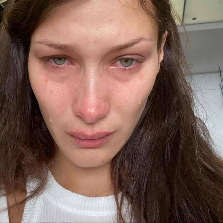 Bella je sa 47 milijuna svojih pratitelja podijelila slike na kojima je uplakana te otkrila kako je to borba koju vodi svaki dan, već nekoliko godina. 