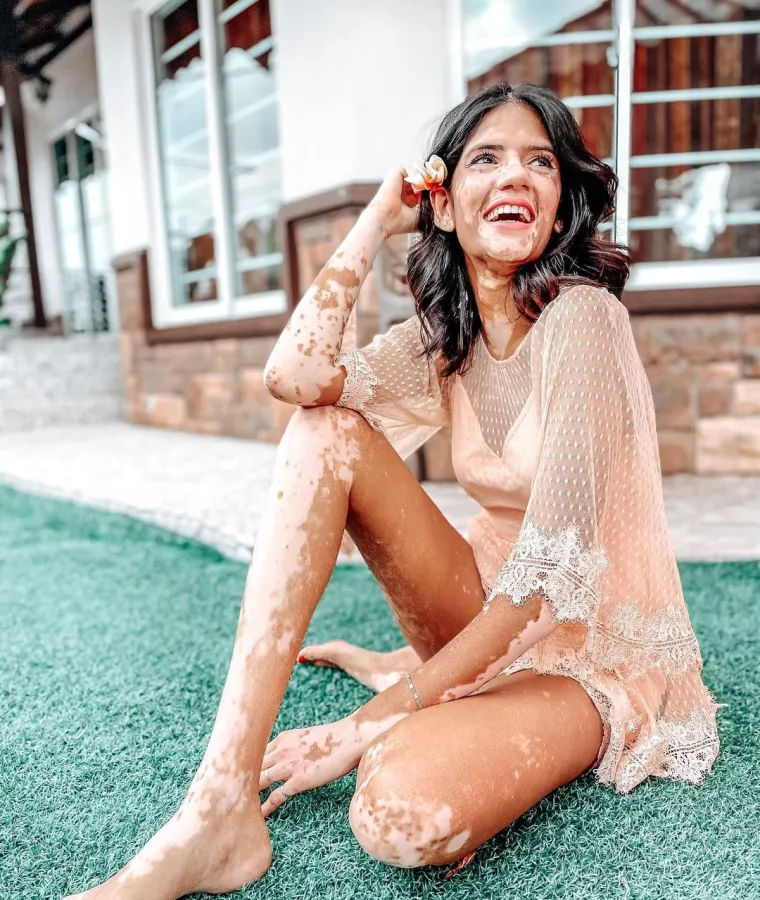 Sonya boluje od vitiliga i uspješan je model: 'Ljudi su mislili da me netko zapalio ili zalio kiselinom'
