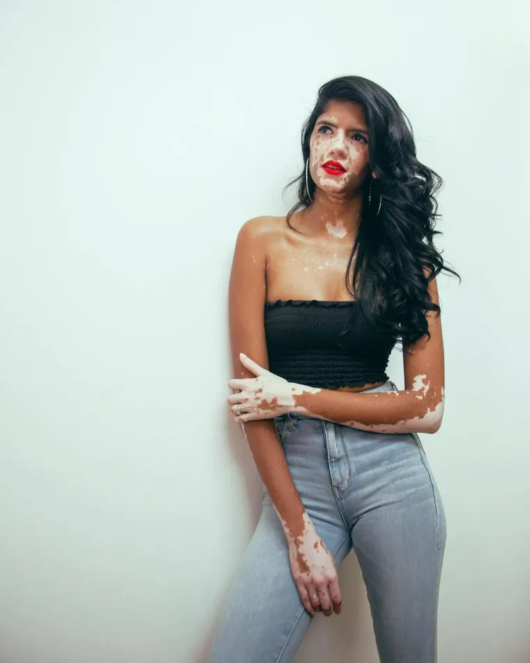 Sonya boluje od vitiliga i uspješan je model: 'Ljudi su mislili da me netko zapalio ili zalio kiselinom'