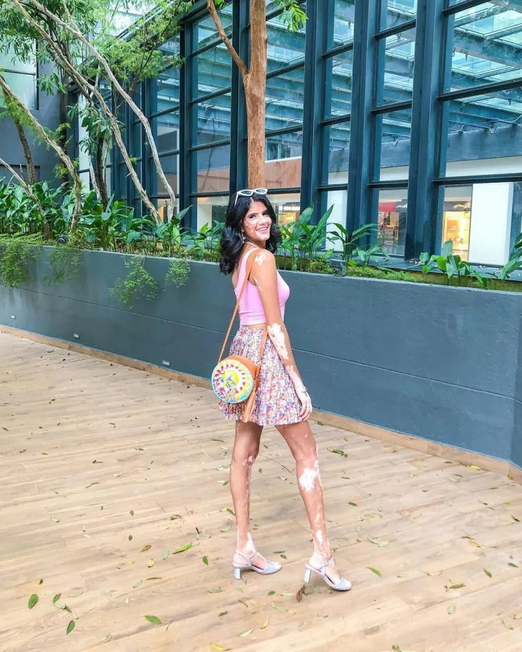 Sonya boluje od vitiliga i uspje&scaron;an je model: 'Ljudi su mislili da me netko zapalio ili zalio kiselinom'