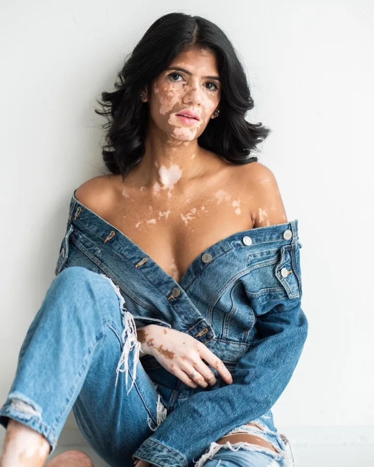 Sonya boluje od vitiliga i uspje&scaron;an je model: 'Ljudi su mislili da me netko zapalio ili zalio kiselinom'