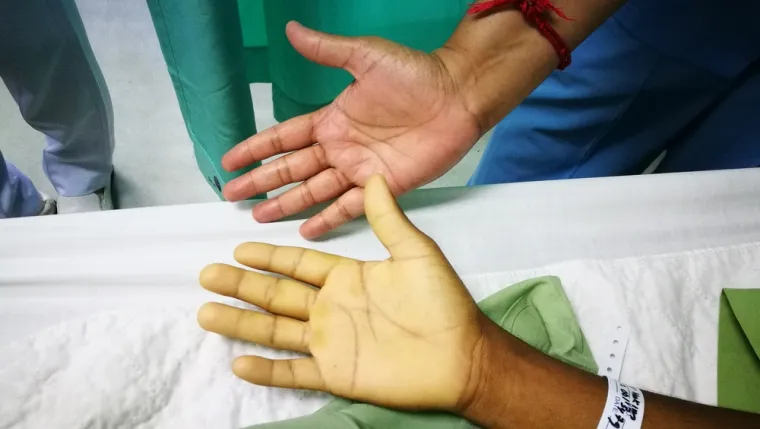 8. Anemija, to je stanje koje se javlja kada osoba ima smanjen udio crvenih krvnih zrnaca u tijelu. 