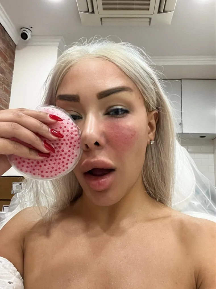 Ovako izgleda lice influencerice Candice nakon vađenja filera iz obraza. Na sljedećoj fotografiji pogledajte kako je ova Instagram manekenka izgledala sa 16 godina i prije svih estetskih zahvata.