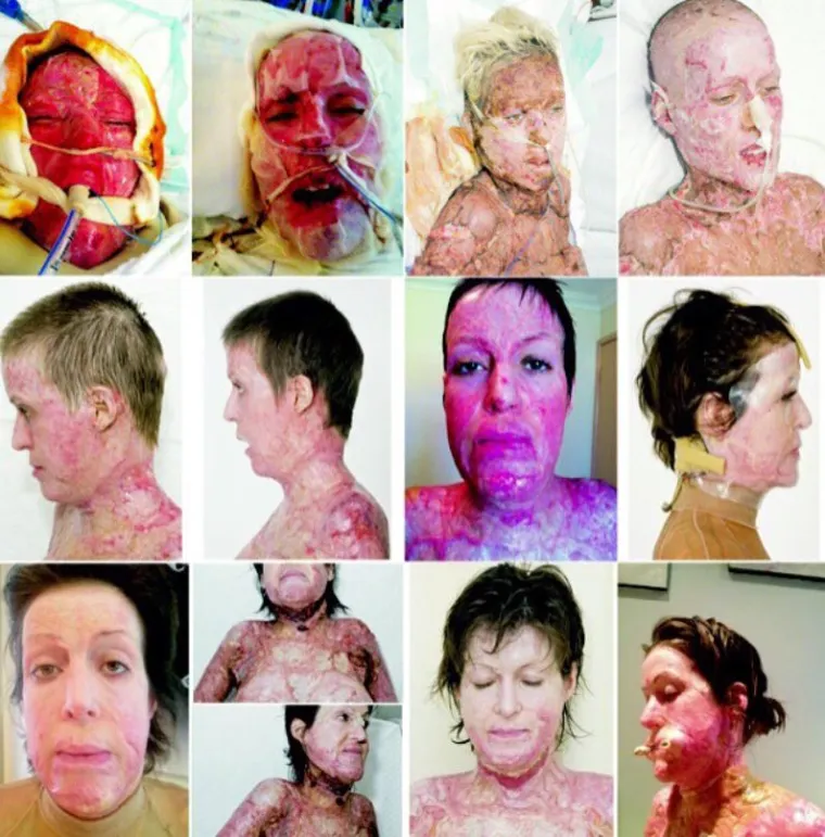 Ljubomorna monstrumka živu ju je zapalila: Nakon 10 godina i 200 operacija skinula se i pokazala nestvarnu ljepotu