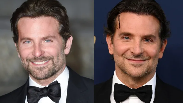 Bradley Cooper (47) privukao je pozornost kada se pojavio na dodjeli nagrada SAG s osjetno drugačijim tenom i nečim što je izgledalo kao potpuno novo lice. Plastični kirurg Dr. Jacques Abrahamian za Radar je otkrio kakve je eventualne zahvate imao slavni glumac. &quot;Napravio je nekoliko dostupnih nekirurških opcija koje uključuju PRP tretmane mikroiglicama, također poznatim kao plazma bogata trombocitima koja koristi vlastitu krv pacijenta i faktore rasta i trombocite koji se nalaze u PRP-u, a koji mogu pomoći kod finih bora i hiperpigmentacija s gotovo nula negativnih posljedica u usporedbi s drugim dostupnim tretmanima&quot;, rekao je Abrahamian.