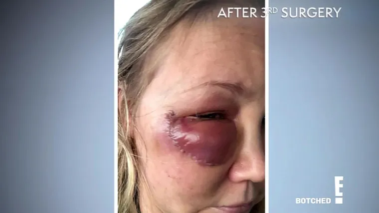 &quot;Morala sam zatvoriti ordinaciju. Nisam mogla spavati i stalno sam trpjela bolove. Zbog toga mi je bilo teško razmišljati, stajati na nogama i sl. Kod mene se ne radi samo o estetskom problemu. Ja sam stalno u agoniji, ne spavam, kosa mi je počela opadati, osjećam se slaba i umorna. Ovo je prava noćna mora&quot;, ispričala je Gina.