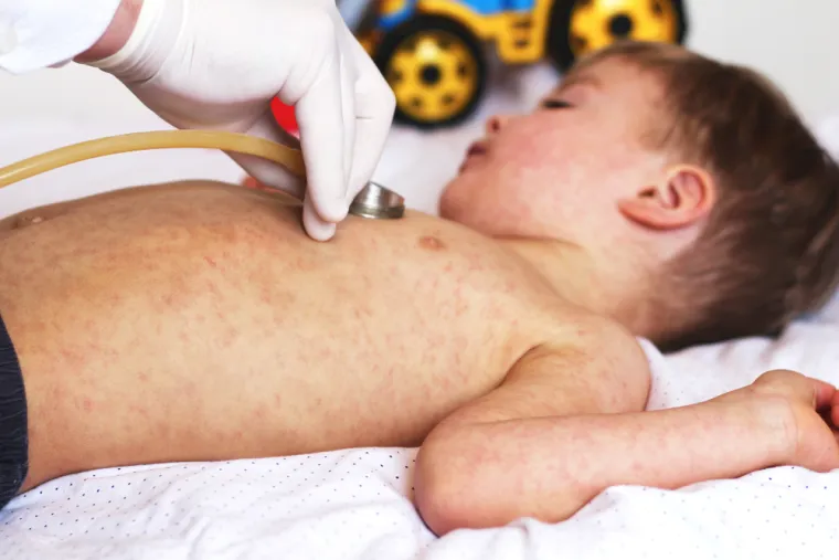 3. Kada je oboljeli najzarazniji:
Bolesnik je najzarazniji u prvih četiri-pet dana. Kad izbije osip, virus je još prisutan u slini i na sluznicama dišnih organa.
