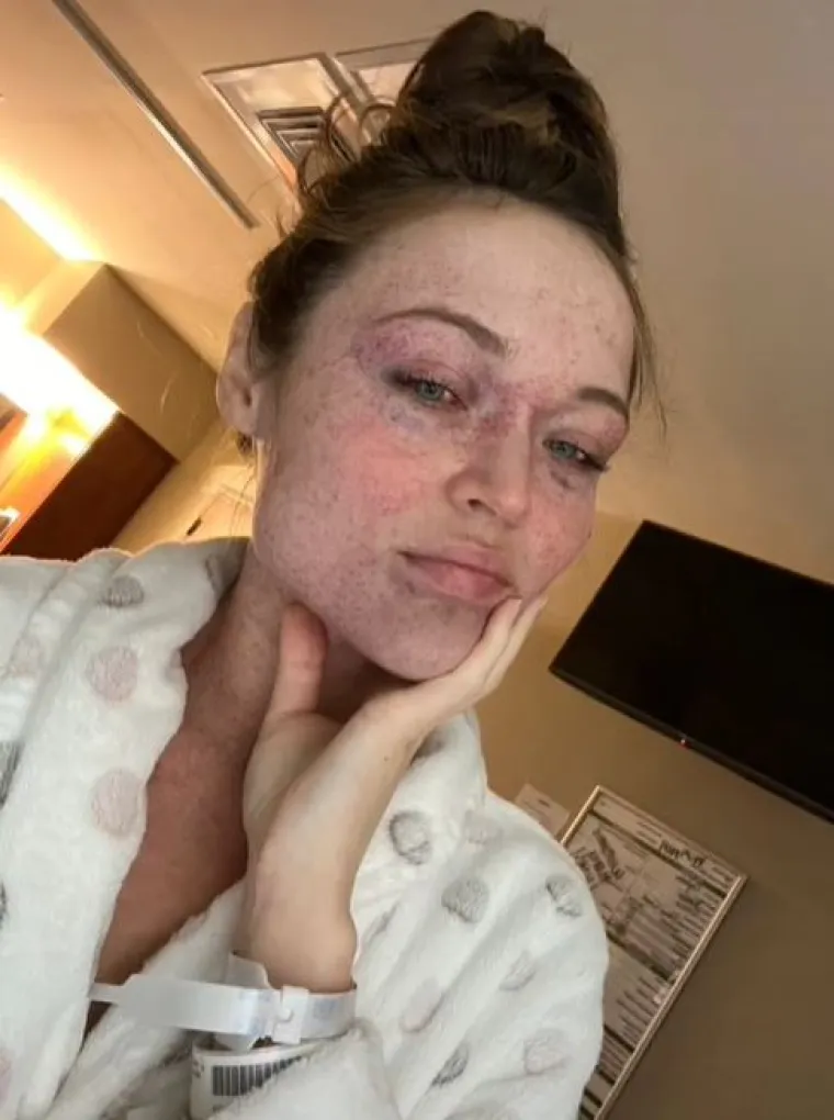 Yelena je imala jedan problem nakon poroda što je pokazala fotografijama na društvenim mrežama. Jedna žena ju je komentirala: &quot;Tiskala je tako jako da su joj popucale krvne žile u očima i koža također.&quot; Druga je dodala: &quot;Oh curo, shvaćam te. Tako je bilo i nakon rođenja moje kćeri&quot;, na što joj je Yelena odgovorila: &quot;Mislila sam da sam jedina. Nitko ne priča o ovome! Nisam znala da je to normalna pojava.&quot;