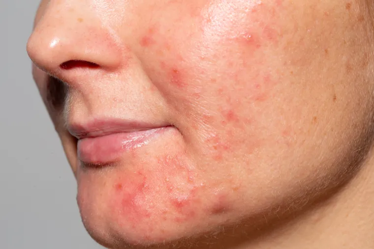 Papule su male, osjetljive crvene kvržice bez očito vidljivog gnoja. &quot;Uz vitamin A, salicilna kiselina također može biti koristan dodatak njihovom liječenju. Radi se o pilingu s antibakterijskim, protuupalnim i antikomedogenim svojstvima, a zbog toga je vrlo učinkovit&quot;, pojasnila je dr. Mansberg.