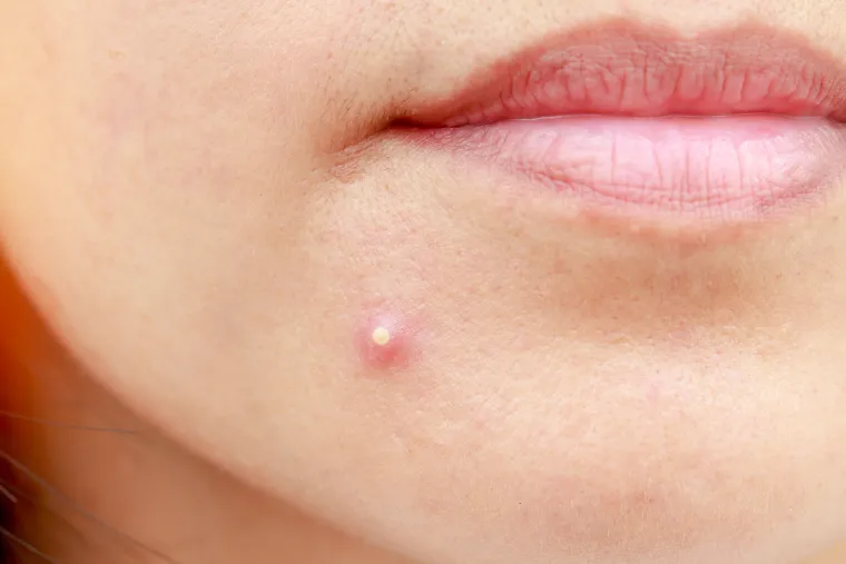Pustule - Za razliku od papula, pustule su prištići koji imaju gnoj. &quot;Ako vas miteser ili bubuljica ne bole ili nisu upaljeni, možete ih istisnuti. Ali budite pažljivi. Temeljito operite i osušite ruke te nježno koristite aparat za uklanjanje mitesera. Ako ne uspije odmah, nemojte forsirati&quot;, upozorila je dr. Mansberg.