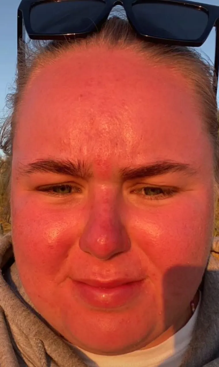 "Nakon sat vremena moje lice je počelo biti crveno i počelo je gorjeti. Nisam ignorirala upozorenja, ali dogodilo se. Ljudi komentiraju da bi imali suosjećanja da nisam TikTokerica, nisam to snimila zbog lajkova", dodala je.