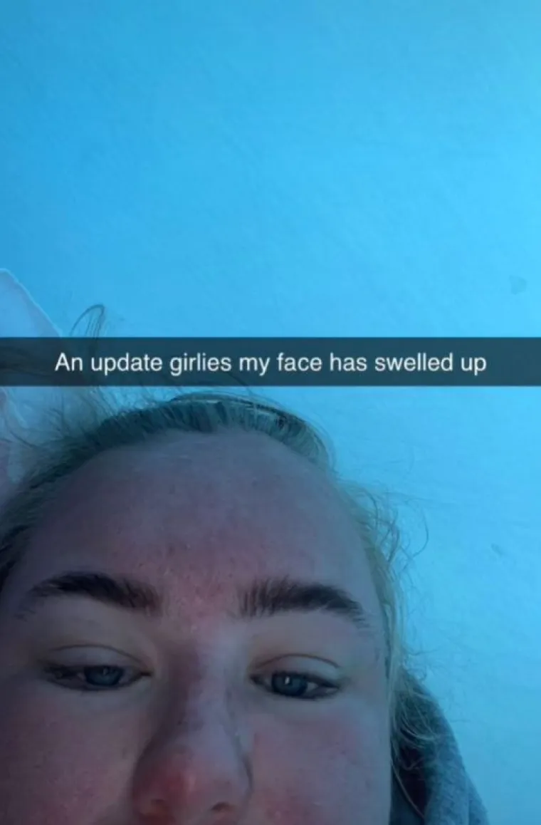 Kasnije joj je lice jako nateklo. "Naučila sam svoju lekciju", poručila je.