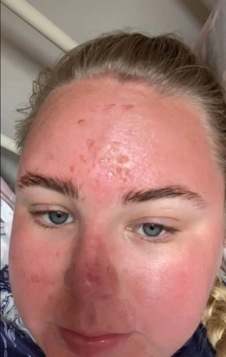 "Ako nemate kremu za sunčanje, izađite van najvi&scaron;e pola sata, naučila sam to na teži način." Na to joj je druga žena dodala: "I meni se to dogodilo, pro&scaron;le su 2 godine, a koža se nije oporavila kako treba."