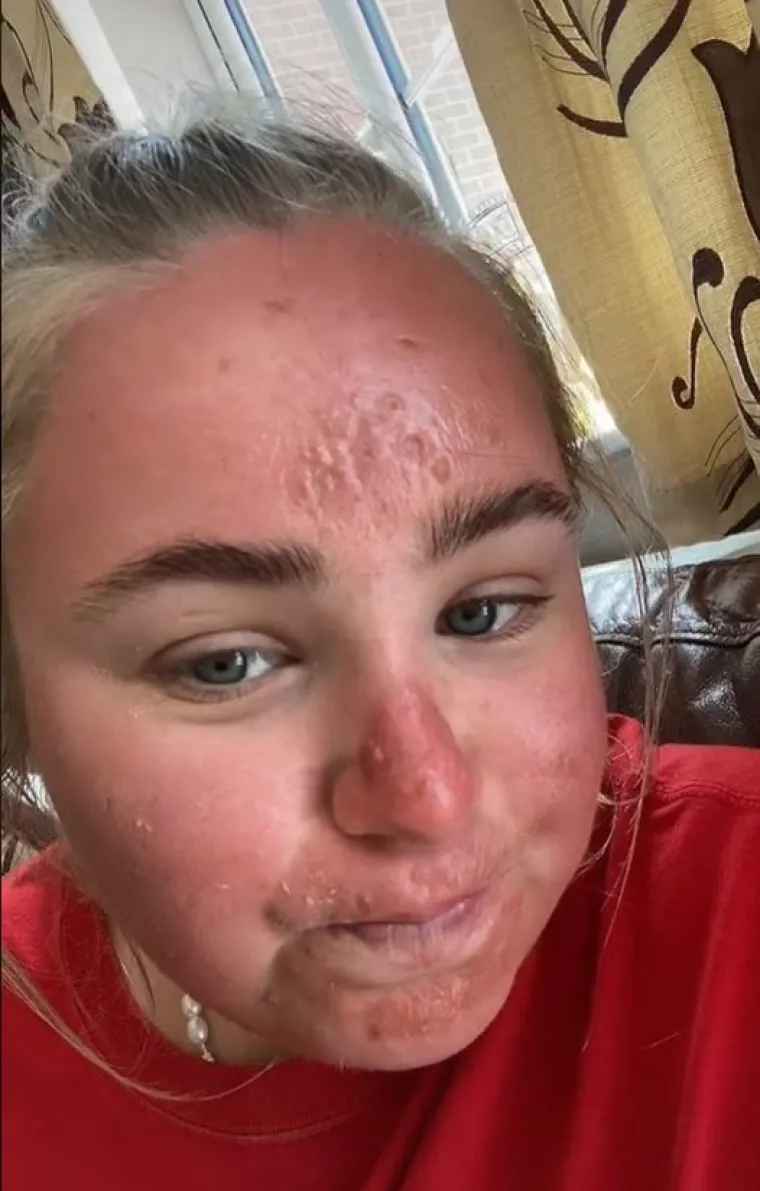 Treća osoba je dala Evi nekoliko savjeta za opekline od sunca u budućnosti: "Ako ubuduće ovako izgori&scaron;, nanesi sudocrem svakih 10 minuta, peći će kao pakao, ali će spriječiti lju&scaron;tenje, obećavam."