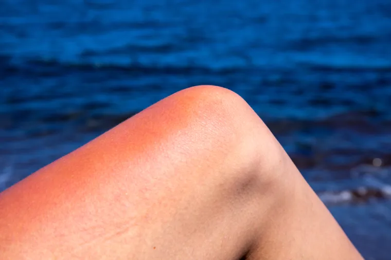 Što je okidač alergije na sunce: 
Kod fotoalergije, izlaganje UV zrakama mijenja tvar iz lijeka, hrane ili proizvoda &quot;u nešto novo što onda tijelo prepoznaje kao stranu tvar i aktivira imunosni sustav&quot;, kaže dr. Barbara Reed, klinička profesorica dermatologije na Sveučilištu Bolnica u Coloradu. &quot;Fotoalergija se ne javlja pri prvom izlaganju nego se razvija s vremenom. Može proći nekoliko dana dok se ne pojavi i obično je više poput osipa koji svrbi nego pretjerane opekline od sunca.&quot; Ako primijetite reakciju, posavjetujte se s liječnikom.
