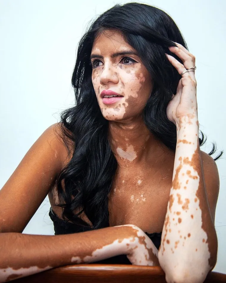 Kožna bolest s kojom se borio i Michael Jackson može biti lijepa: Hrabre žene s vitiligom skinule se do kraja